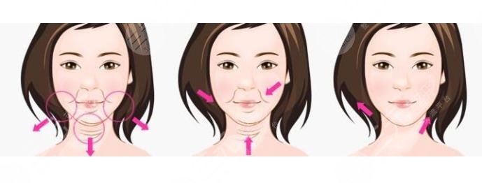 天津第三中心醫(yī)院整形美容科面部抗衰抗皺手術(shù)經(jīng)歷分享