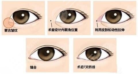 開內(nèi)眼角多久可以恢復(fù)