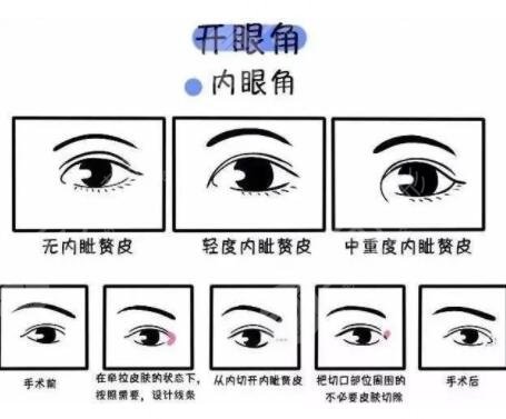 開內(nèi)眼角手術(shù)注意什么