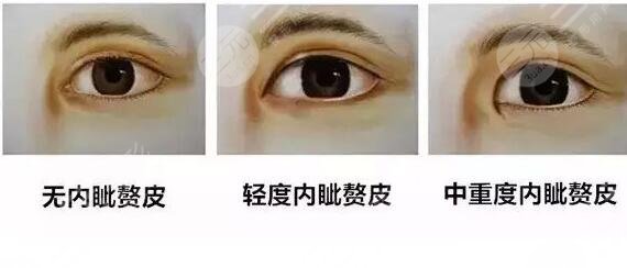 開眼角手術(shù)的成好嗎