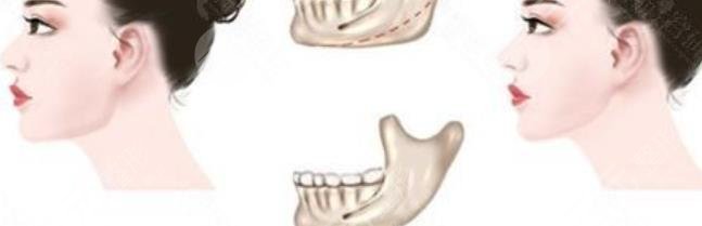 金一秀磨骨價格多少