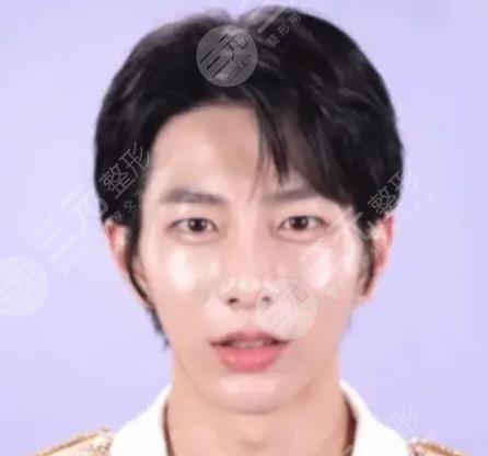 崔普閔整容盤點(diǎn)