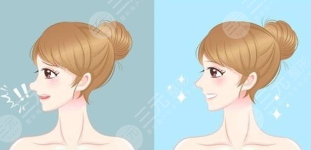 天津河東麗人整形價格表|隆鼻失敗修復真人案例分享