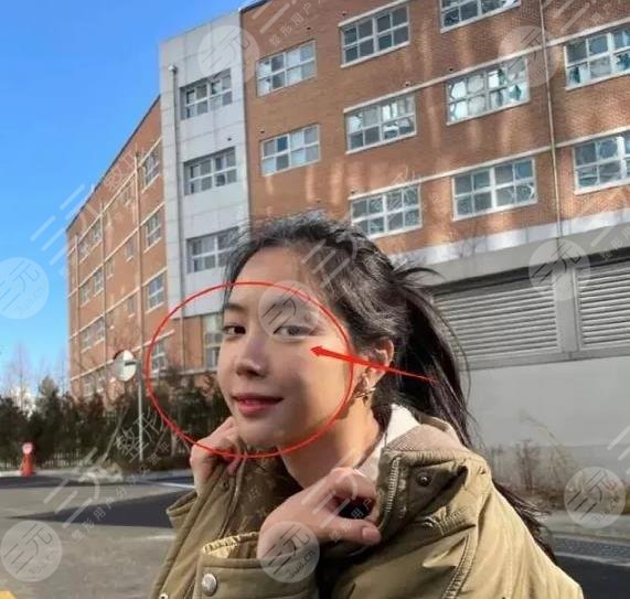 前Apink門(mén)面近照鼻子透光疑似整容失敗?