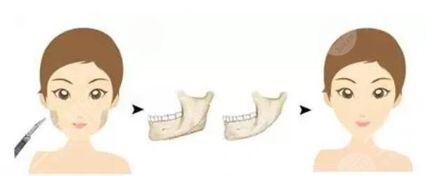 磨骨手術(shù)過程