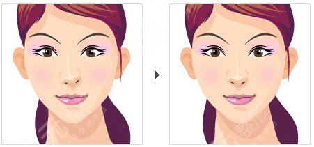 非手術(shù)隆鼻+鼻尖肥大整形 御姐范十足