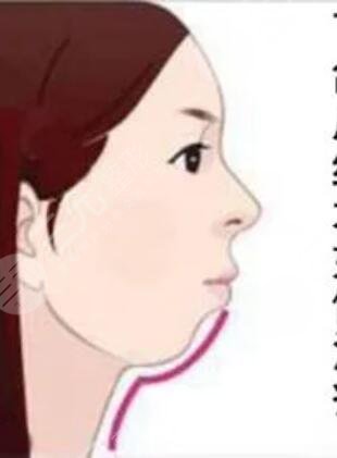 廣州曙光醫(yī)學(xué)美容醫(yī)院,假體墊下巴