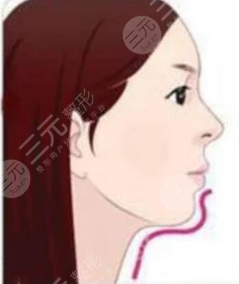 廣州曙光醫(yī)學(xué)美容醫(yī)院,假體墊下巴
