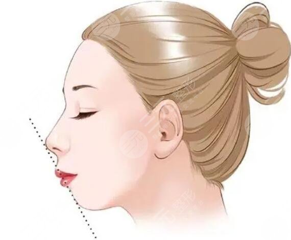 廣州曙光醫(yī)學(xué)美容醫(yī)院,假體墊下巴