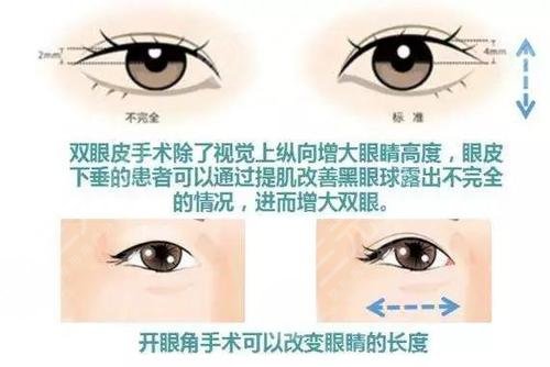 開眼角對比果圖文講解！前后區(qū)別一覽，康康你是否需要do一下！