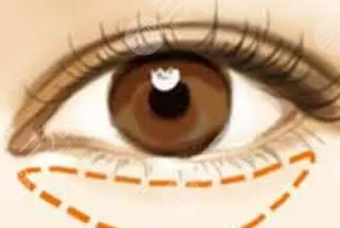 被眼袋困擾多年忍無可忍做手術(shù)去除