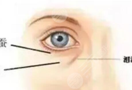 被眼袋困擾多年忍無可忍做手術(shù)去除