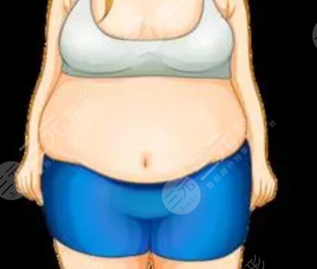 怎么減肚子上的贅肉 腰腹部吸脂20天之后