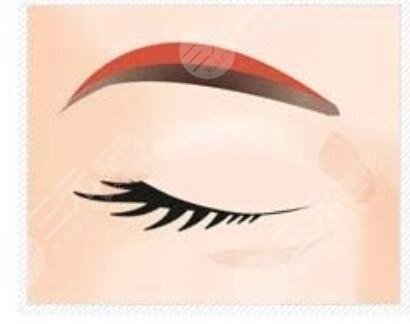 切眉手術(shù)1-7天的前后對(duì)比圖，恢復(fù)過程沒有什么后遺癥出現(xiàn)