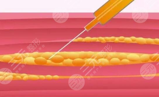 腹部吸脂前后對(duì)比和吸脂過(guò)程多圖分享