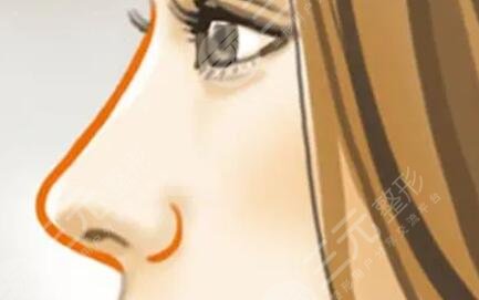 隆鼻整形恢復(fù)的很好,沒有什么異樣