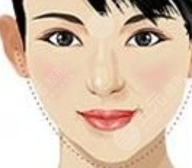 假體墊下巴恢復(fù)后