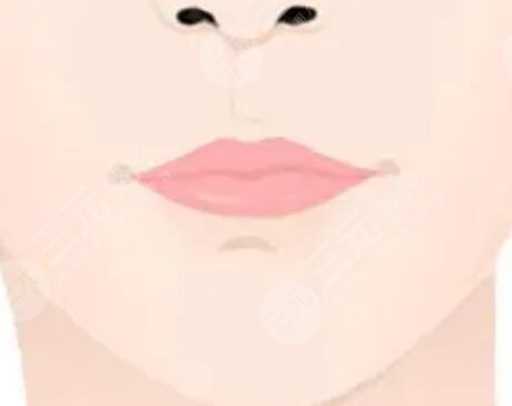 m唇手術(shù)恢復過程