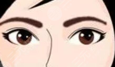 洗眉術(shù)后20天