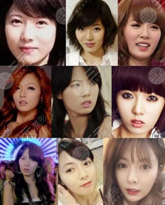 泫雅有沒有動過臉?動了哪些地方?