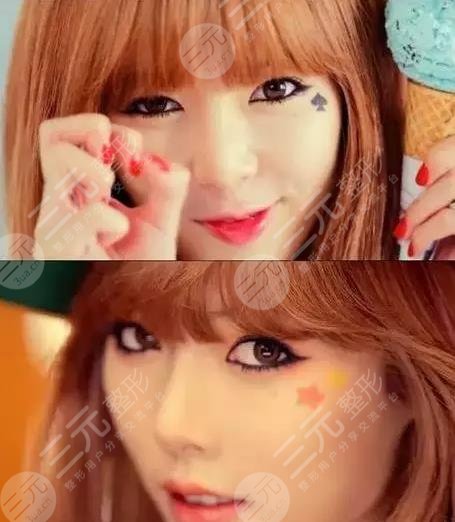 泫雅有沒有動過臉?動了哪些地方?