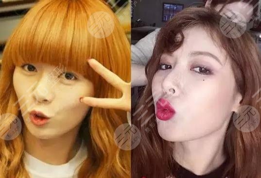 泫雅有沒有動過臉?動了哪些地方?