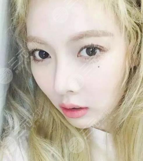 泫雅有沒有動過臉?動了哪些地方?