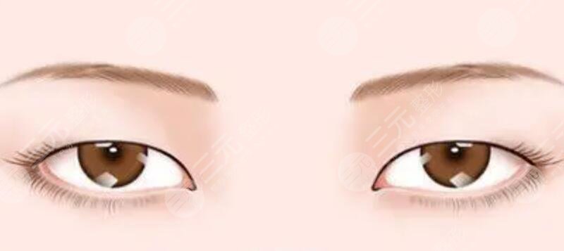 成都駐顏整形切開雙眼皮果反饋，對(duì)比驚艷！