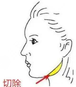 四川嬌點整形成好嗎？下頜角切除恢復(fù)日記呈獻