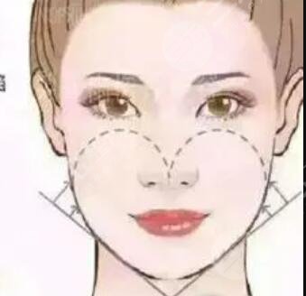 四川友誼整形靠譜嗎？附埋埋提升果案例反饋