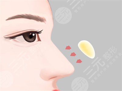 成都素美整形口碑如何？隆鼻整形果對比分享