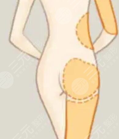 溫州星范吸脂貴不貴？誠(chéng)享吸脂瘦腿術(shù)后恢復(fù)過程