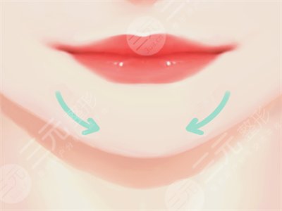 墊下巴案例 假體墊下巴恢復(fù)過程分享