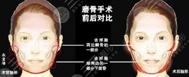 磨骨手術有什么風險和后遺癥？看完你還想做嗎？