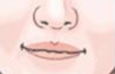 豐唇手術(shù)前后對比照片