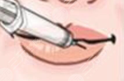 豐唇手術(shù)后照片一個月