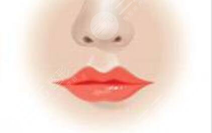 豐唇手術(shù)后照片三個月