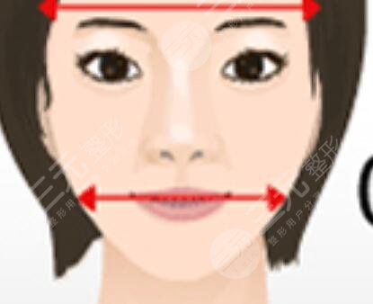 下頜角手術(shù)成功案例