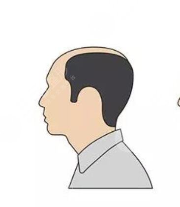 東莞長安有植發(fā)醫(yī)院嗎