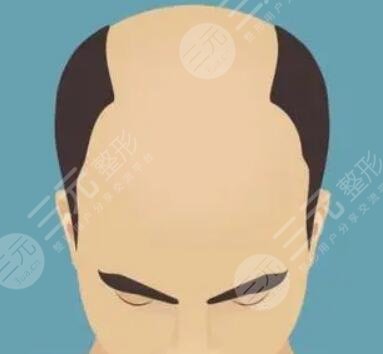 重慶新生毛發(fā)醫(yī)院植發(fā)經(jīng)歷分享