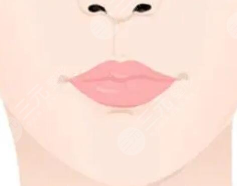 厚唇改薄七天恢復圖