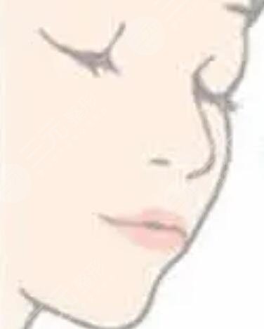 厚唇改薄七天恢復圖