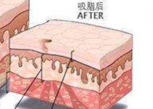 歐洲之星溶脂瘦肚子:術后第7天