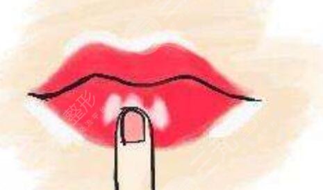 m唇手術(shù)真人案例分享