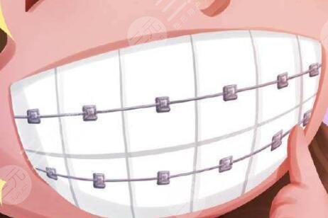 北京協(xié)和醫(yī)院種植牙怎么樣？附我的種植牙過程及術后果