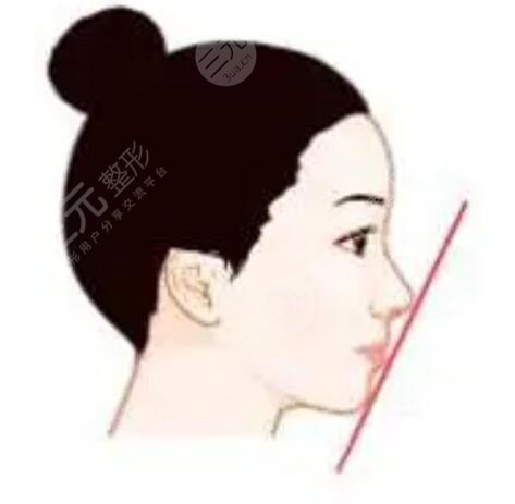 鼻翼縮小術(shù)后果對比圖