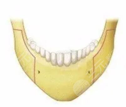 年前做的大腿吸脂塑型，現(xiàn)在有點(diǎn)后悔做腰部的吸脂