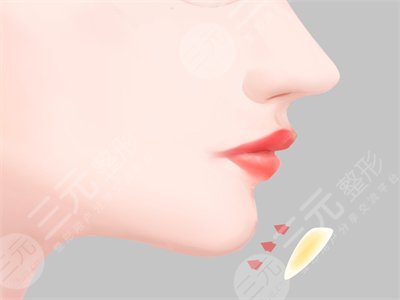 假體墊下巴恢復(fù)過程圖，讓我的面部有著更標(biāo)準(zhǔn)的比例！