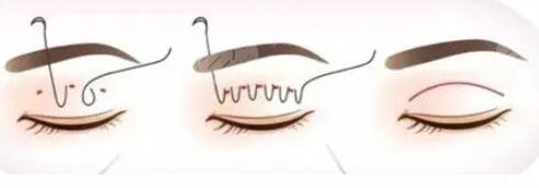 切開雙眼皮真實(shí)反饋-成都嬌點(diǎn)整形果