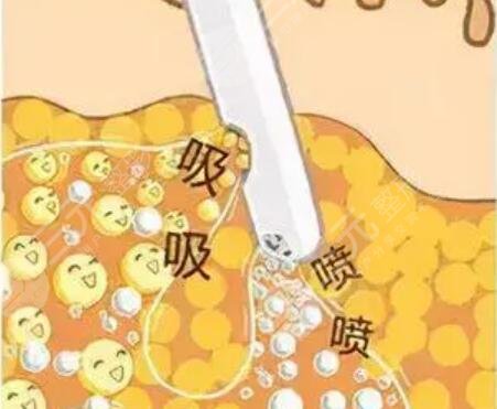 臀部吸脂15天恢復(fù)圖